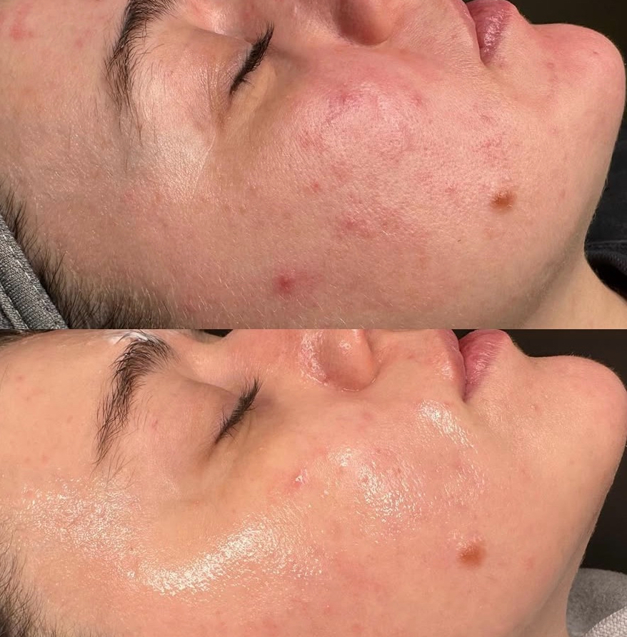 Metamorfoza po zabiegu laserowym – gabinet Kleczew