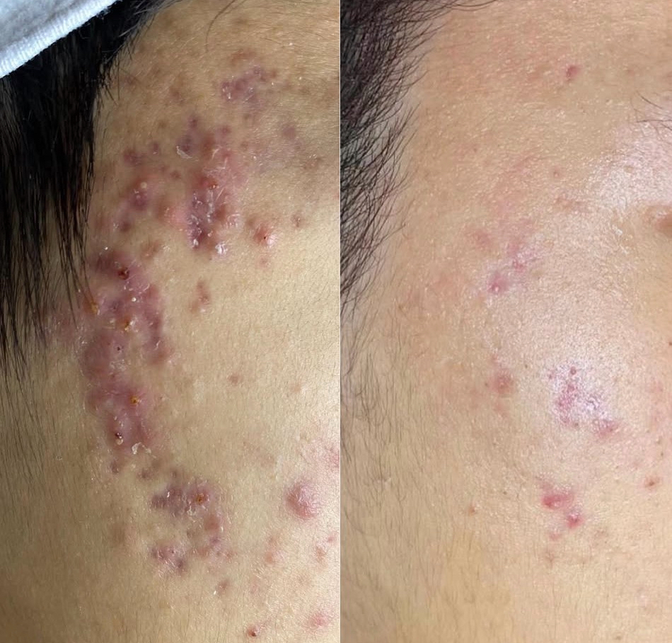 Efekt epilacji laserowej – Turowska Clinic Kleczew