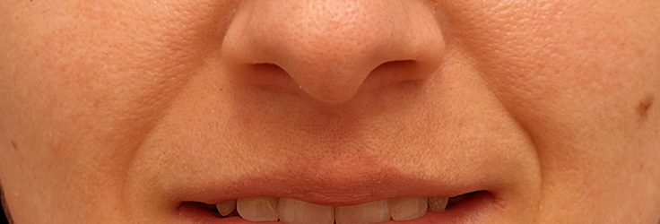 Wypełnianie bruzd nosowo-wargowych kwasem hialuronowym – Turowska Clinic