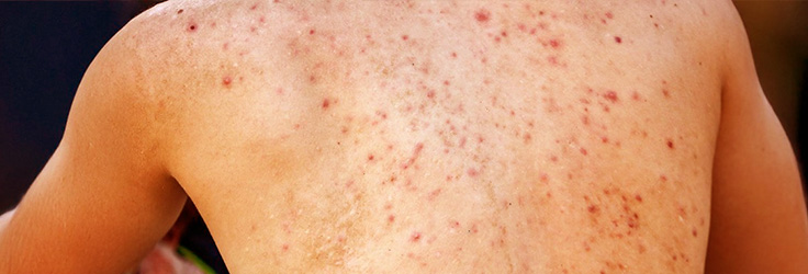 Oczyszczanie pleców – trądzik i zaskórniki, Turowska Clinic Kleczew