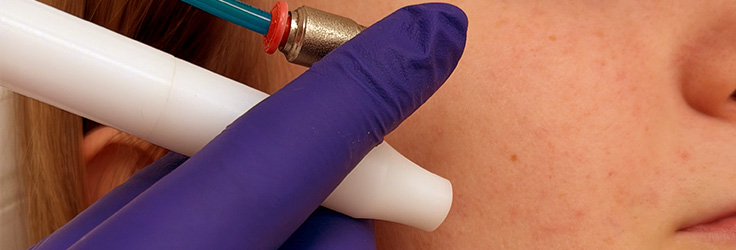 Oxybrazja – głębokie oczyszczanie skóry, Turowska Clinic Kleczew